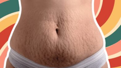 5 ways to remove stretch Marks which will actually