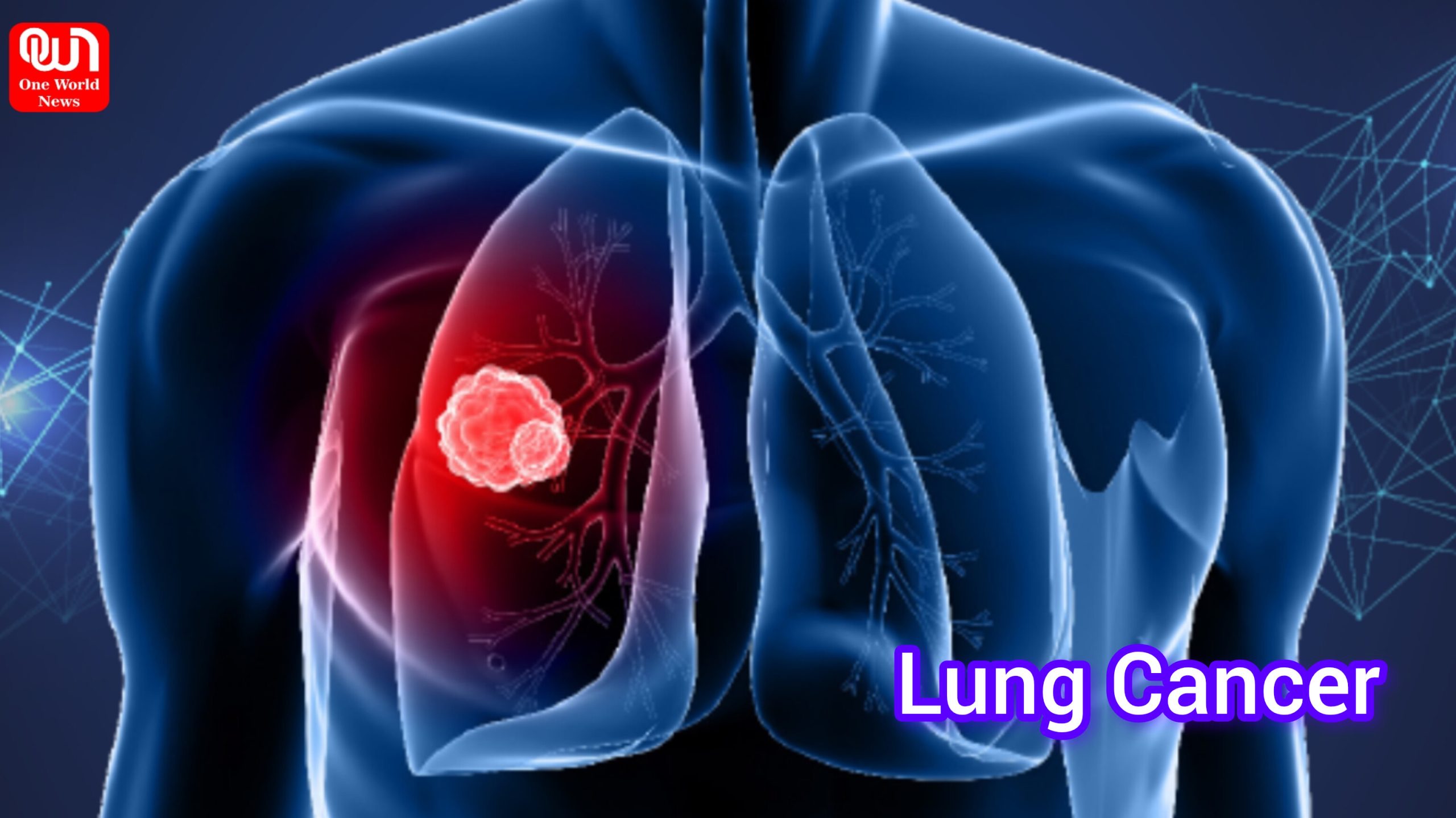 Lung Cancer