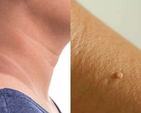 Dark Neck And Skin Warts