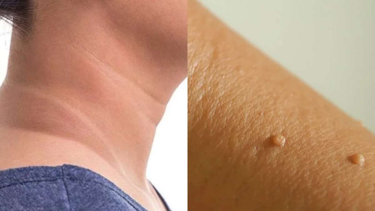 Dark Neck And Skin Warts