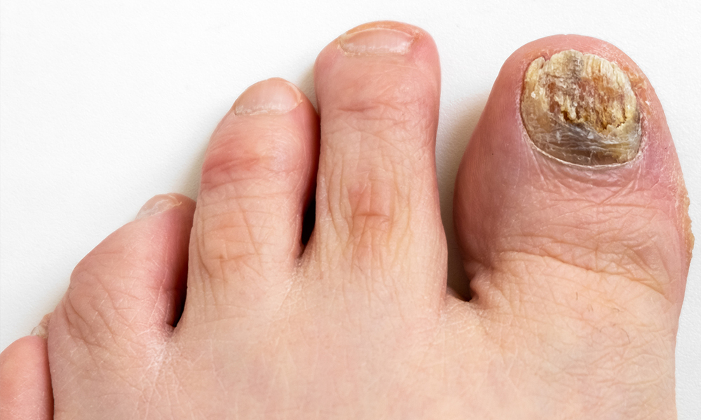 Monsoon Foot Care Tips