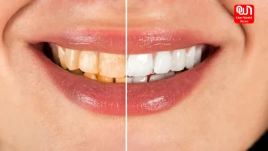 Teeth Whitening Tips