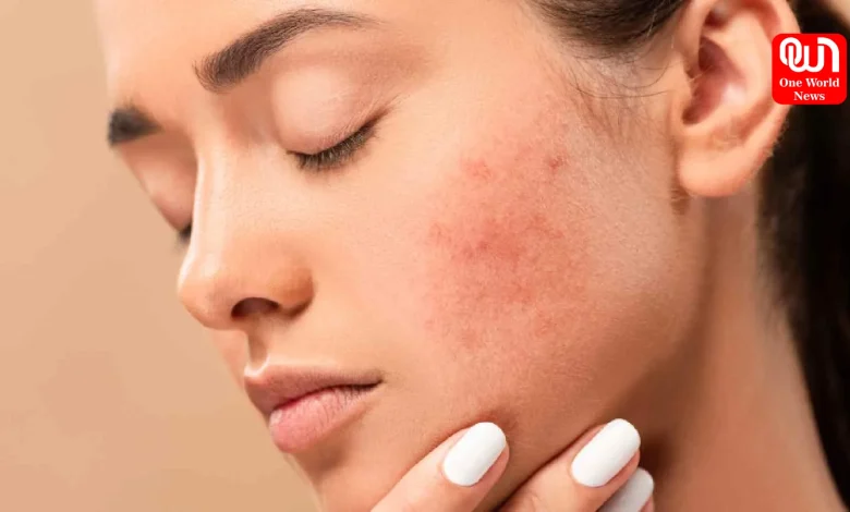 Acne And Gut Health