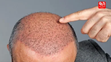 Hair Transplant