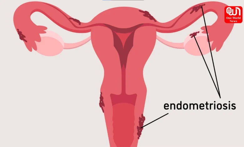 Manage Endometriosis Symptoms