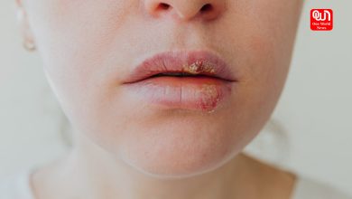 Chapped Lips Causes