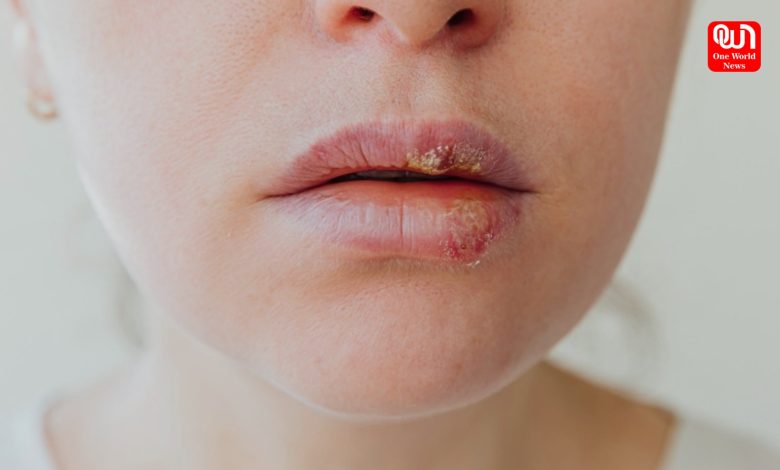 Chapped Lips Causes