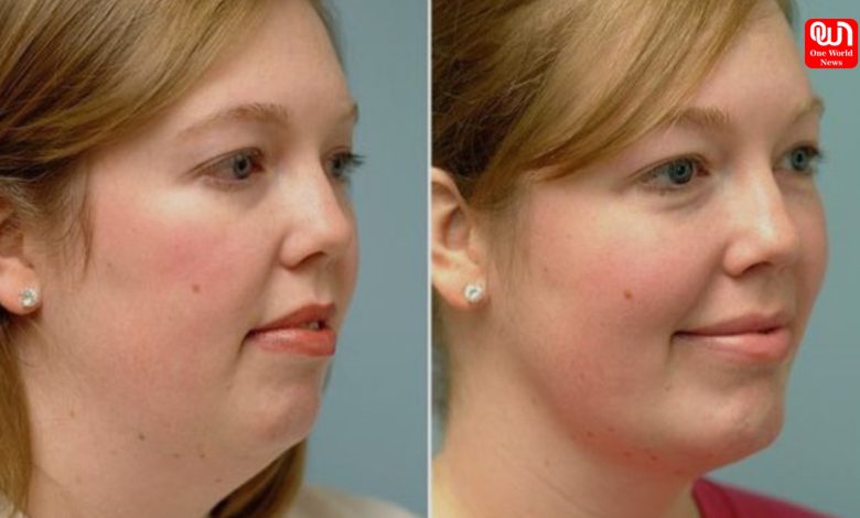 Facial exercises for double chin