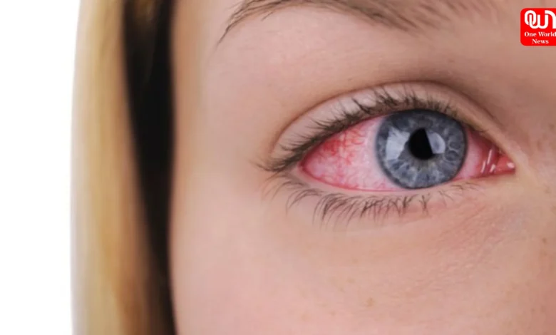 Red Eye Season