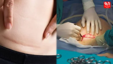 C-Section
