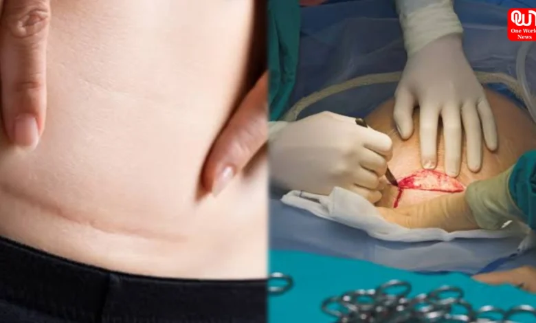 C-Section