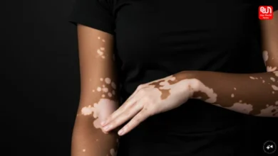 Vitiligo