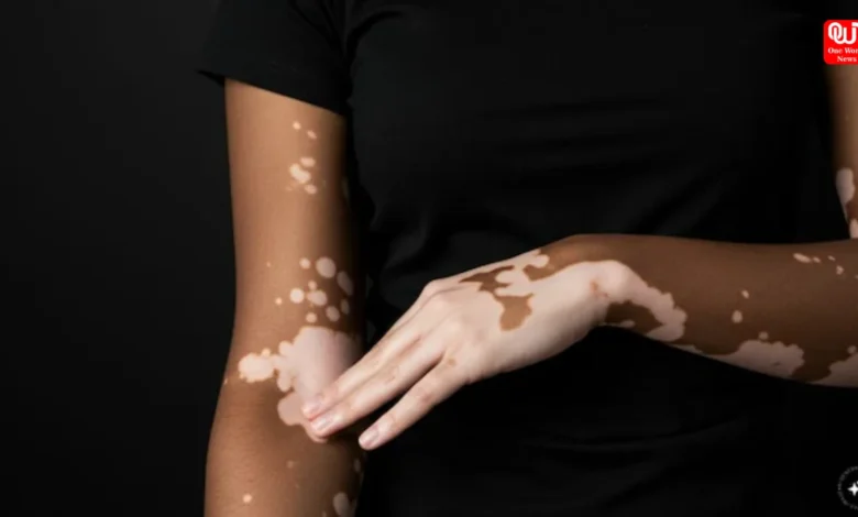 Vitiligo
