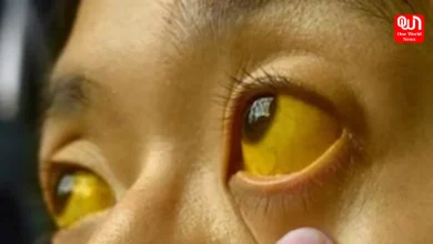 Major Causes of Jaundice