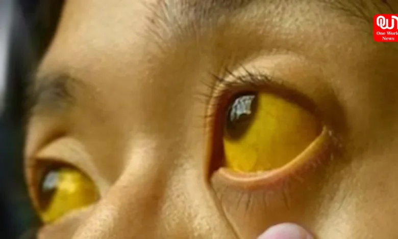 Major Causes of Jaundice