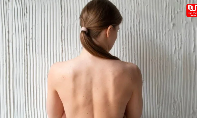 Back Acne