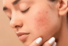 How To Get Rid Of Pimples