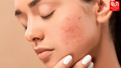 How To Get Rid Of Pimples