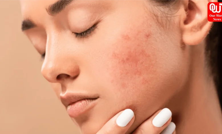 How To Get Rid Of Pimples