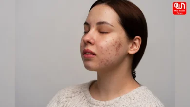 How To Treat Skin Purging