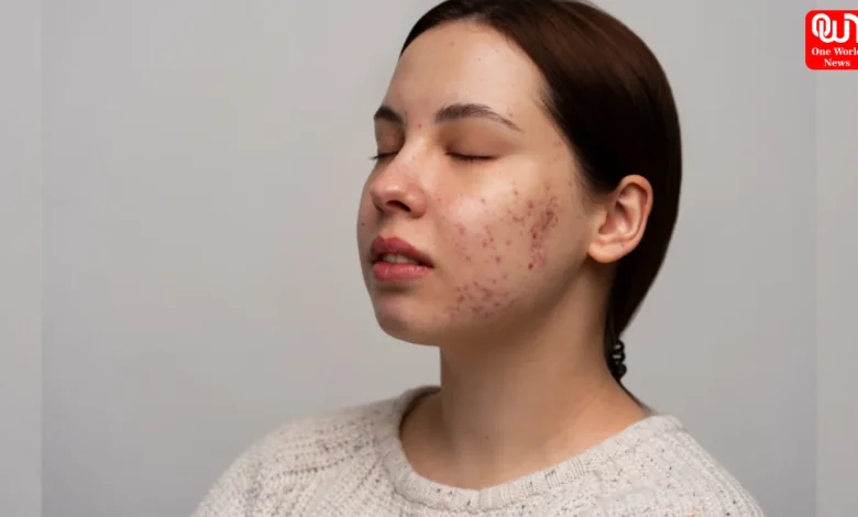 How To Treat Skin Purging