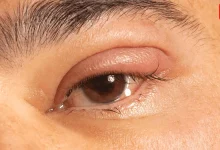 Rid Of Puffy Eyes After Crying