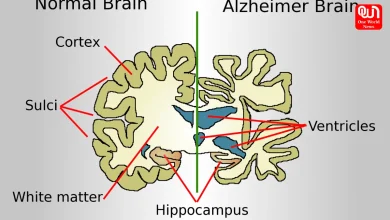 Alzheimer's Disease