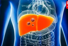 Fatty Liver And Cancer