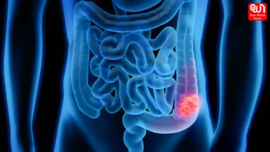 Blood in Stool