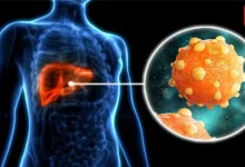 Fatty Liver And Liver Cancer Risk