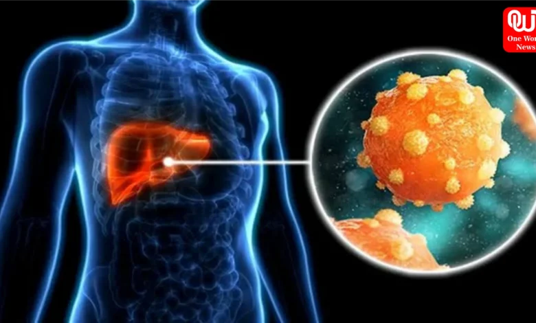 Fatty Liver And Liver Cancer Risk