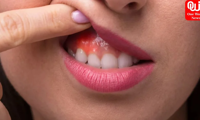 Mouth Cancer Signs