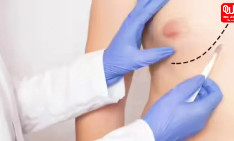 Male Breast Cancer