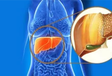 Lean Fatty Liver Disease