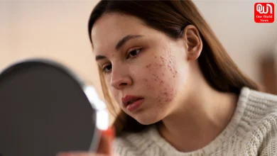 Pimples Before Periods
