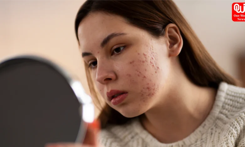 Pimples Before Periods