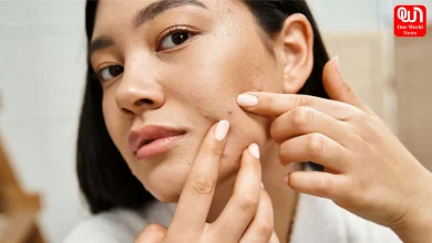 Monsoon Acne Problem