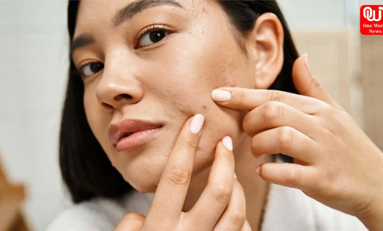 Monsoon Acne Problem