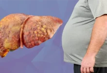 Fatty Liver Disease