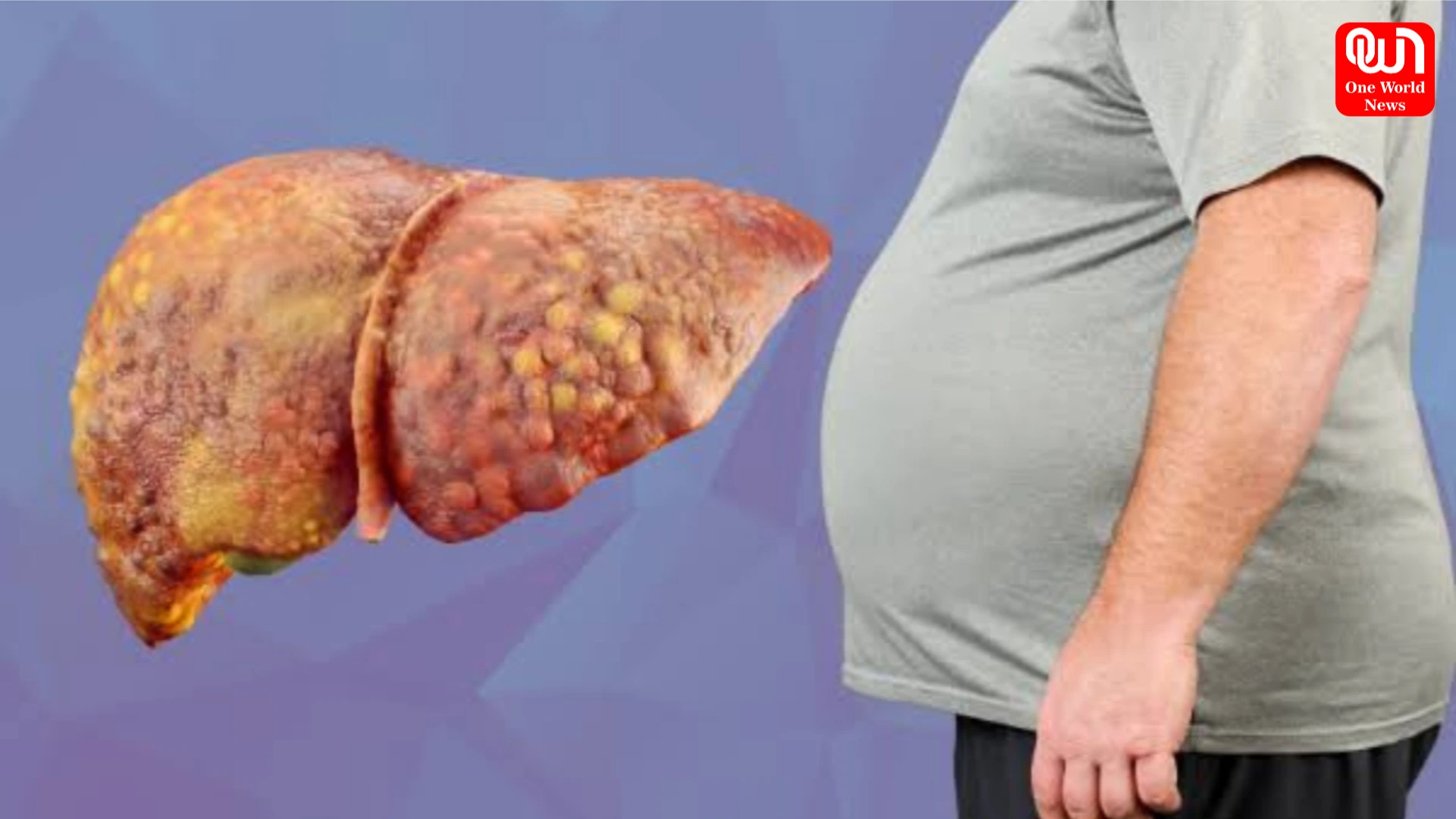 Fatty Liver Disease