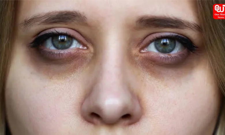 How To Remove Dark Circles