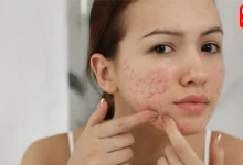 Pimples on the face