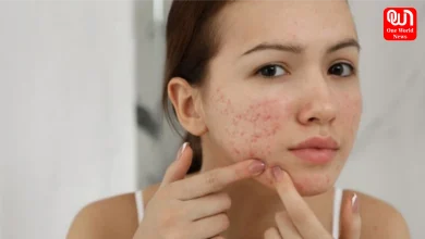 Pimples on the face